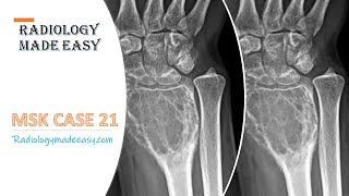 FRCR Radiology  A 40 year old male presented with Lump in the left wrist joint  MSK case 21 [upl. by Ynej]