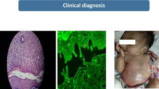 Epidermolysis Bullosa  Spot Diagnosis  9  Pediatrics [upl. by Ahmed]