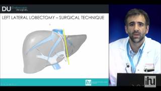 Surgical technique of hepatectomies [upl. by Eiba]