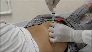 im injection buttock How to Give an IM Intramuscular Injection Ventrogluteal Buttock Muscle [upl. by Atikan]