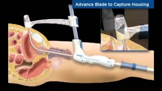 TSPeC® Illustrated Procedure  German [upl. by Yank522]