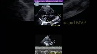 M  Mode Studies amp Measurements Mitral Valve [upl. by Atirak]