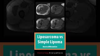 How to differentiate liposarcoma from lipoma  MSK Radiology  1000 cases in 100 days  video 41 [upl. by Notserc]