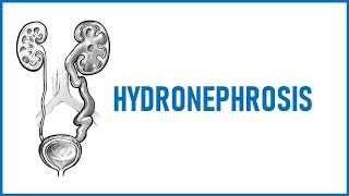 Hydronephrosis Lecture [upl. by Torres]