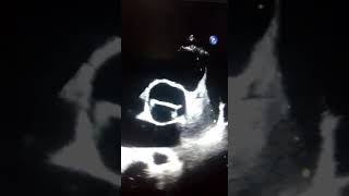 Bicuspid aortic valve appearance on Echocardiography [upl. by Scarlett181]