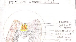 DENTAL CARIES  PART 2  Oral pathology dentalcaries [upl. by Ver131]