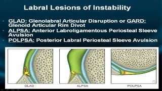 Shoulder MRI Instability Part IV [upl. by Corabelle754]