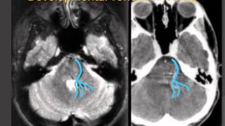 Developmental Venous Anomaly quotVenous Angiomaquot  a Vascular Malformation [upl. by Mulderig]