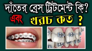 দাঁতে ব্রেস পড়ানোর খরচ কত টাকা  Orthodontics braces treatment cost dental braceby smile bd [upl. by Cuthburt899]