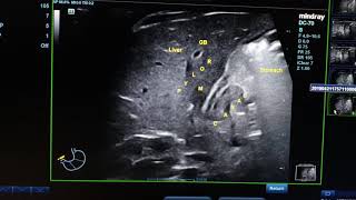 Hypertrophic Pyloric Stenosis HPS [upl. by Gunning]