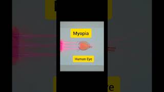 Human eye myopia myopia treatmentmyopia can be cured myopia treatment in hindi humaneye myopia [upl. by Babcock]