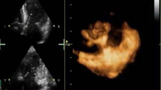 3D MITRAL REGURGITATION PROLAPSE P2 AND P3 [upl. by Adnorat]