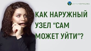 НАРУЖНЫЙ ГЕМОРРОЙ Как наружный узел quotсам может уйтиquot [upl. by Figueroa574]