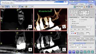 PreXion Training Tips 3D Slab for Endo [upl. by Nerek300]