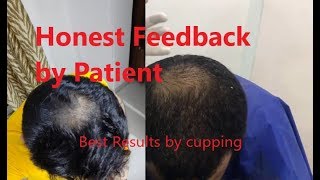 Honest feedback of patient after 2 sessions of cupping Hijama for hair regrowth Hair fall at delhi [upl. by Analli]