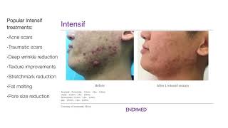 EndyMed Intensif MicroNeedling [upl. by Namrej]