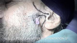 Extra oral mandibular nerve block with Absolute Injection for Trigeminal Neuralgia [upl. by Atsev]