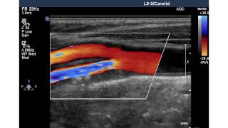 ICA STENOSIS Case [upl. by Spillihp]