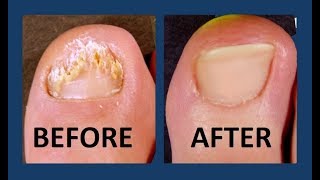 Toenail Fungus Commercial  Worlds Best Toenail Fungus Treament 2018 [upl. by Frey86]