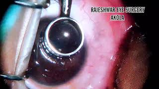 RECURRENT CORNEAL EROSION TREATMENT WITH ALCOHOL DELAMINATION [upl. by Anairda585]