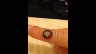 wart on finger after freezing with liquid nitrogen [upl. by Burtie144]