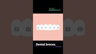 Ceramic Teeth Braces or Clear teeth aligners cost in Kerala [upl. by Ahsemaj]