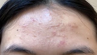 how to get rid of pimples on forehead in only 3 minutes [upl. by Anwahs]