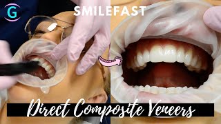 Direct Composite Veneers  SMILEFAST TRANSFORMATION [upl. by Hafirahs868]