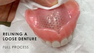 Relining a Loose Denture  Full Process [upl. by Garreth]