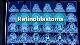 Retinoblastoma Orbital tumors Classification [upl. by Hekking456]