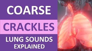 Coarse Crackles Lung Sounds Audio Causes Auscultation Nursing NCLEX Review [upl. by Araiek]