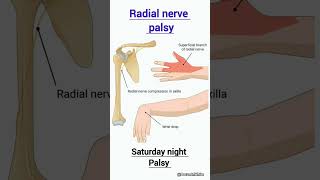 Radial nerve palsy  Saturday palsy  viralvideo radialnerve palsy axilla [upl. by Prentiss]