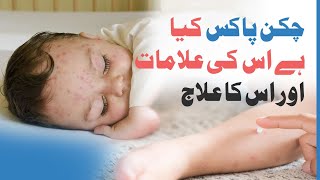 Understanding Chickenpox Symptoms Treatment and Expert Advice by Dr Mohsin Hasan [upl. by Ronald698]