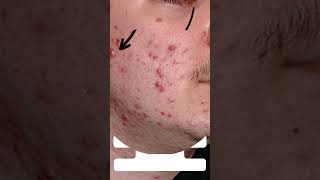 The Ultimate Guide to Treating Papulopustular Acne [upl. by Darline]