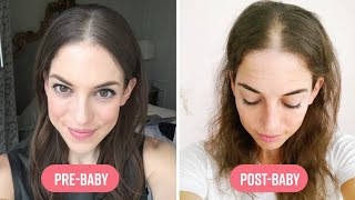 How I Coped With Extreme Hair Loss After Pregnancy I Mom Bod [upl. by Nodnart691]