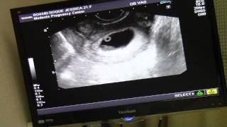 8 Week Ultrasound  Baby 4 [upl. by Laidlaw]