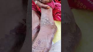 TINEA CORPORIS fungaldisease skincare ulcers viralvideo shorts medicine physician [upl. by Frederick]