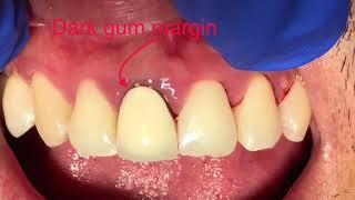 Comparison between PFM Porcelain Fused To Metal And Zirconium Crown [upl. by Burgess]