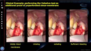 INTRALIFT Histology Study JOMS Audioslides [upl. by Marou]