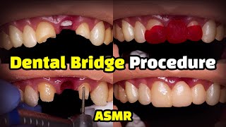 Dental Bridge Procedure [upl. by Sivam]