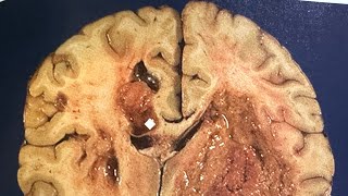 Glioblastoma Awareness Day and Brain Tumor Concept pathology glioblastoma surgery brain [upl. by Carrillo]