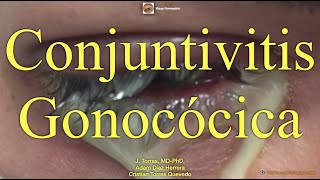 Conjuntivitis Gonocócica [upl. by Ramahs659]