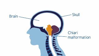 Understanding Chiari malformation [upl. by Shayna]