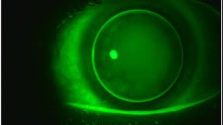 Multifocal GP Contact Lenses Video 3 [upl. by Tavey]