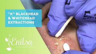 Blackheads Whiteheads Extractions on quotKquot  Part 2 [upl. by Notnilk]