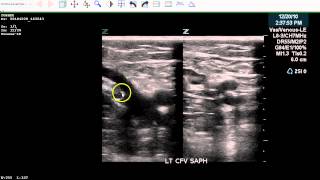 Positive LE DVT Exam  Case Study [upl. by Emiolhs919]