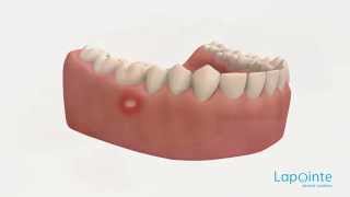 Ulcer  Lapointe dental centres [upl. by Harve301]