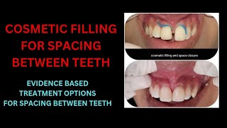 GAP CLOSED BETWEEN FRONT TEETH  MIDLINE DIASTEMA TREATMENT OPTIONS  SPACING BETWEEN TEETH [upl. by Onateyac]