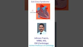 What is Sick Sinus Syndrome [upl. by Anni]