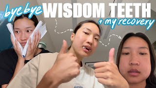 Maxillary Impacted Wisdom Teeth Extraction  Dental Minute with Steven T Cutbirth DDS [upl. by Ahsiniuq]